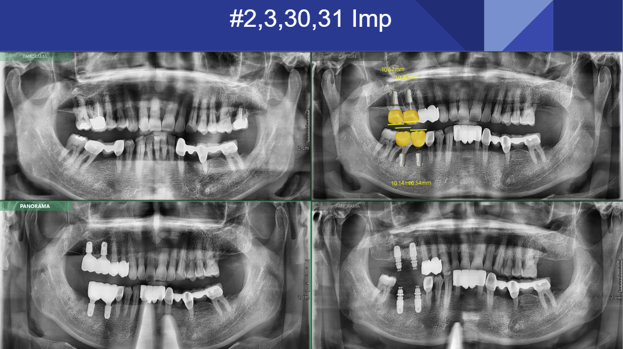 Four-panel panoramic X-ray montage showing implant treatment for teeth 2, 3, 30 and 31, with the original planning annotations