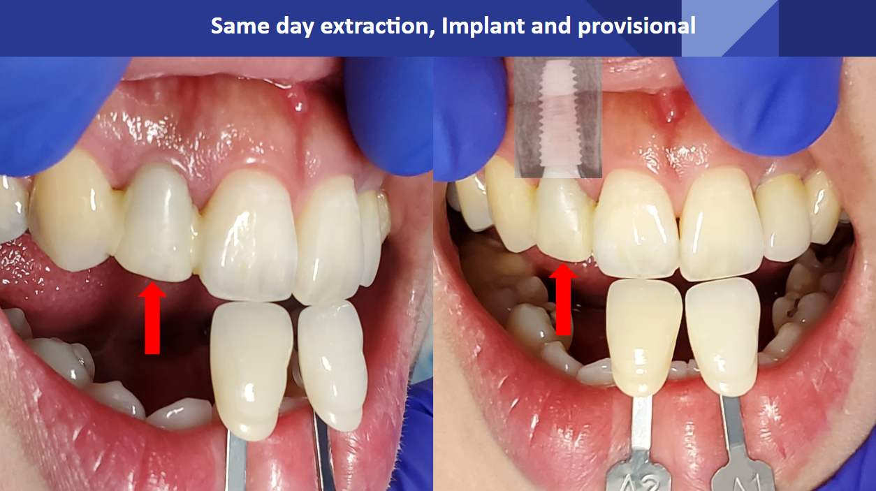 Side-by-side implant case photos labeled same-day extraction, implant and provisional, with the original arrows and X-ray inset